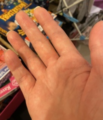 Intermittent blue finger after surgery 