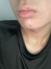 Mole on lip