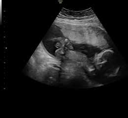 Baby had legs crossed, any guesses on gender?