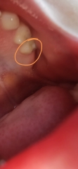 Do these look like cavities?