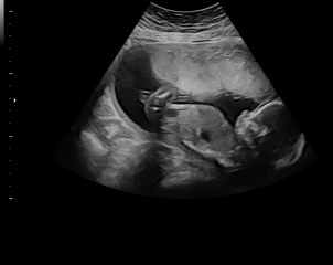 Baby had legs crossed, any guesses on gender?