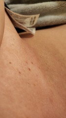 Spots/bumps under boobs - pic attached 
