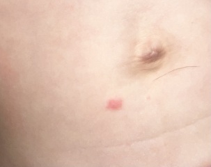 Is this chicken pox?