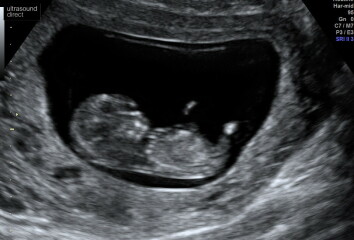 Bub theory for my 12  week scan 