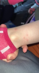Chicken pox or?