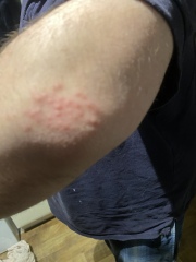 What’s this rash on my husband? Driving me insane!