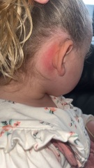 Mastoiditis?