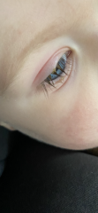 Sons eye is swollen, red and yellow discharge….