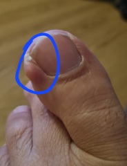 Big toe  anyone know what this lump is? (Pic attached)