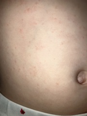 Is this chicken pox?
