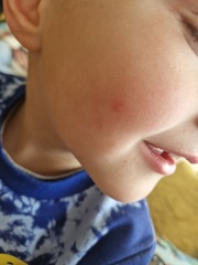 Is this the start of chicken pox?