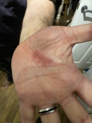 What’s this rash on my husband? Driving me insane!