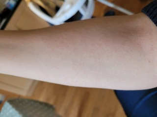 Prickly arm rash