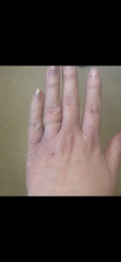 Simple question about Eczema