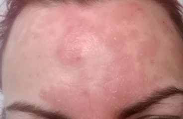 Psoriasis -advice before GP appointment 