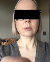 My droopy jowl mini face lift result pics