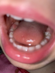 Is this normal? 2 year old molars