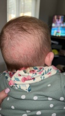 Rash on DDs head?