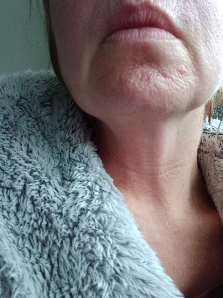 Microneedling or botox for pores?