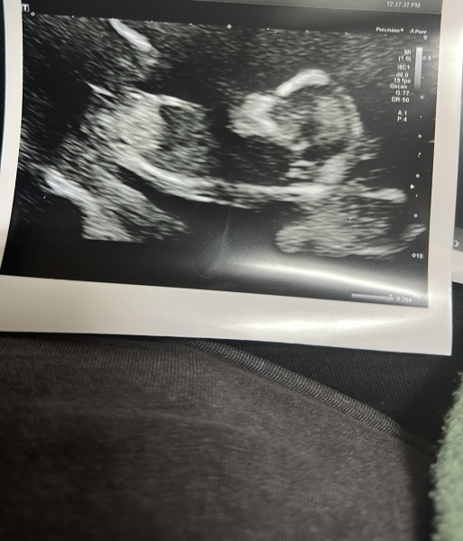 Third baby scan, gender predictions
