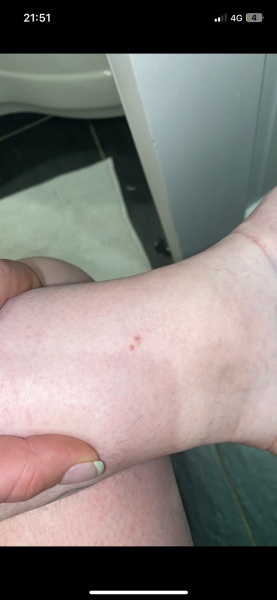 To think these are chicken pox?