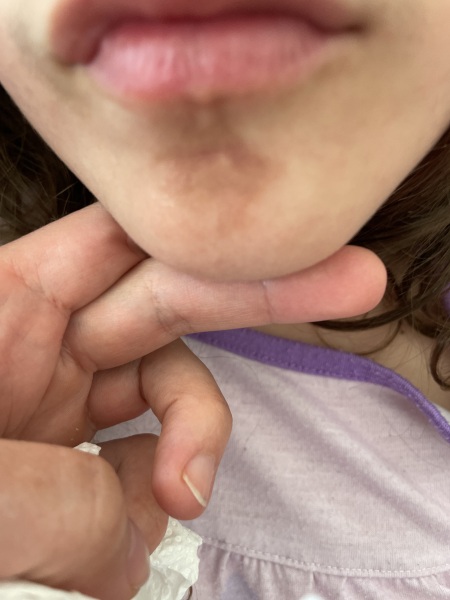 To be worried about this spot on daughters face?