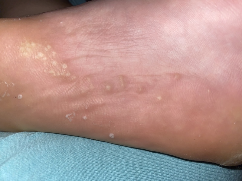 Does anyone know what these holes are on the sole of my foot?