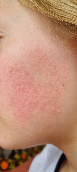 Is this rosacea on my 12yo DD's face?