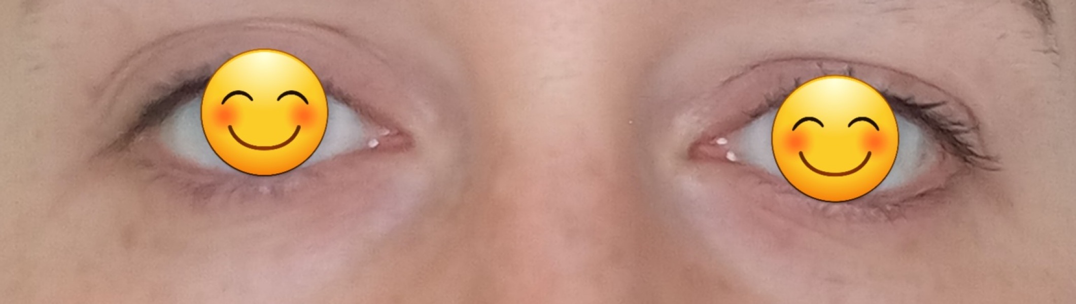 Eye wrinkles