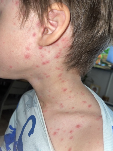 Chicken pox 