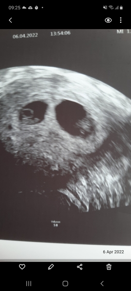 Twins or just a random blob ultrasound pic!!!! 
