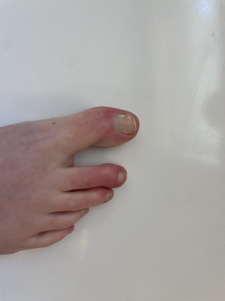 Weird toe colour (with pic)