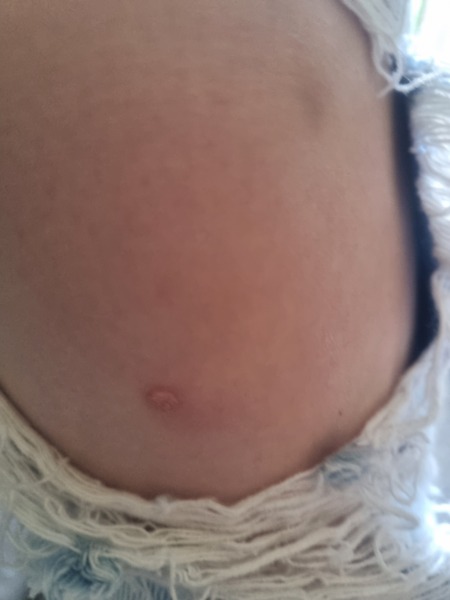 Does this look like a wart?