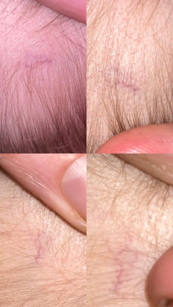 Toddler bumped back of head, Advice.