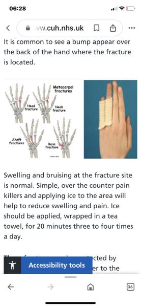 Broken little finger
