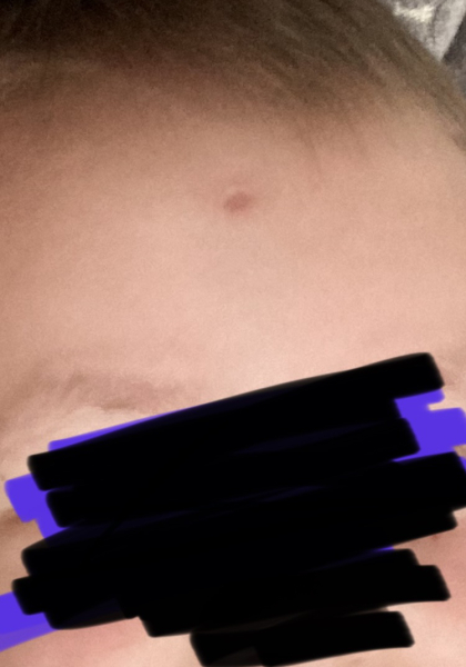 Large chicken pox scar