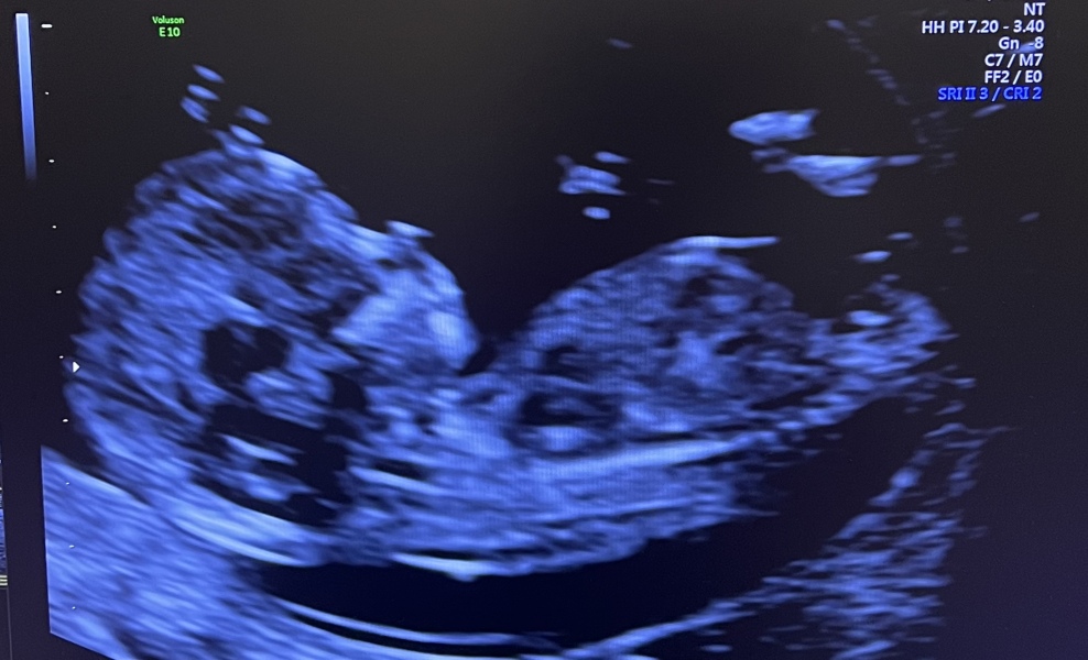 SMEP-ing our way to a BFP 🍁🍂🐿️🍂🍁 Part 2