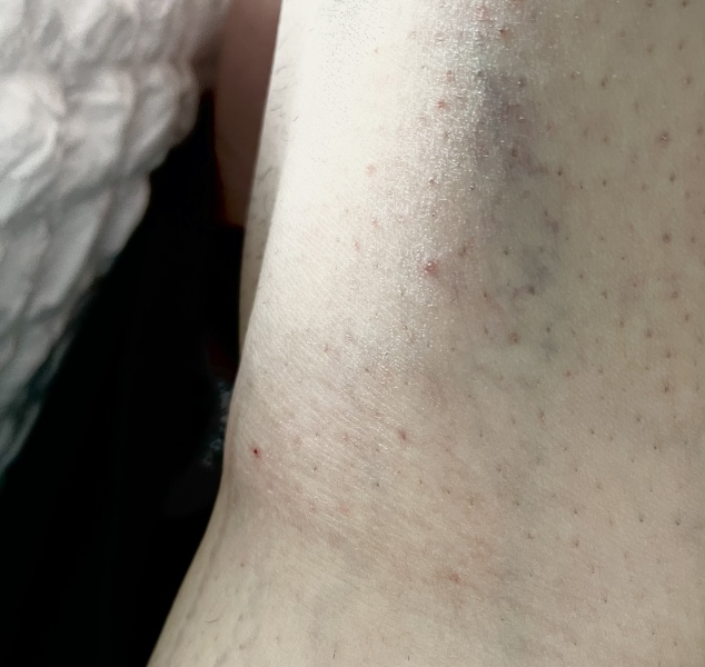 Vain on my upper leg. 