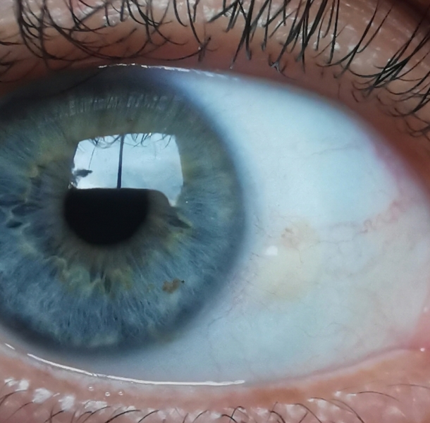 Brown/yellow spots on eye (sorry, weird eye photos)