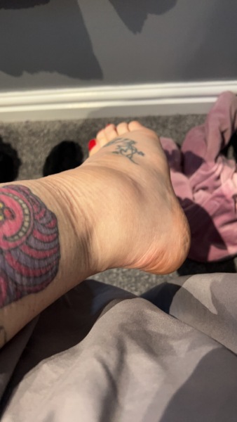One foot swollen 