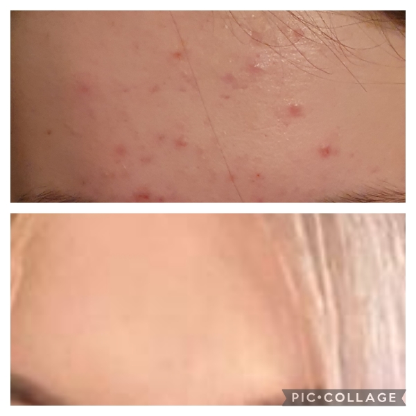 Skincare during puberty