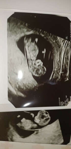 Gender of miscarried baby