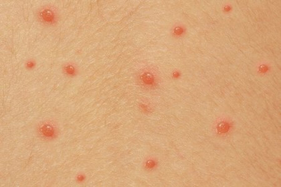 To think these are chicken pox?