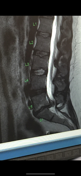 18-year-old DS's excruciating, years-long sciatica – need hope