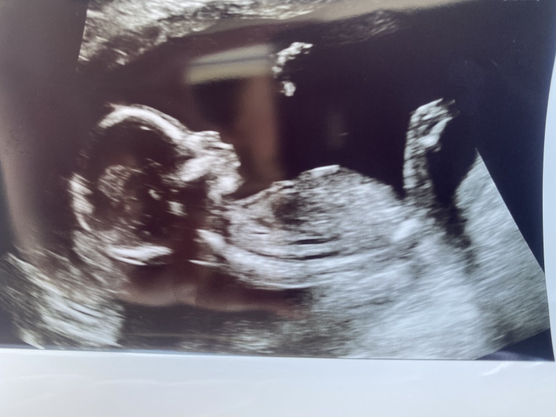 What do you think baby is from 20 week scan
