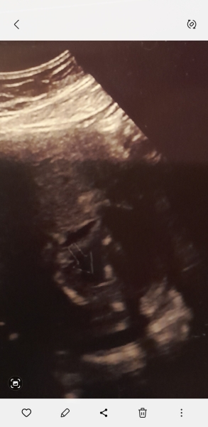 Gender scan - boy or girl?? 😁