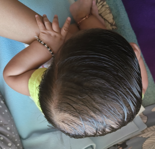 Is this severe plagiocephaly?  