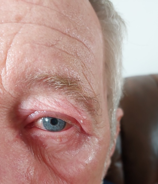 Just what is wrong with his eye?
