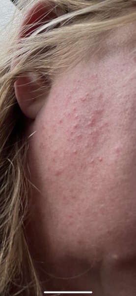 menopausal skin! This keeps happening! (pic inc)