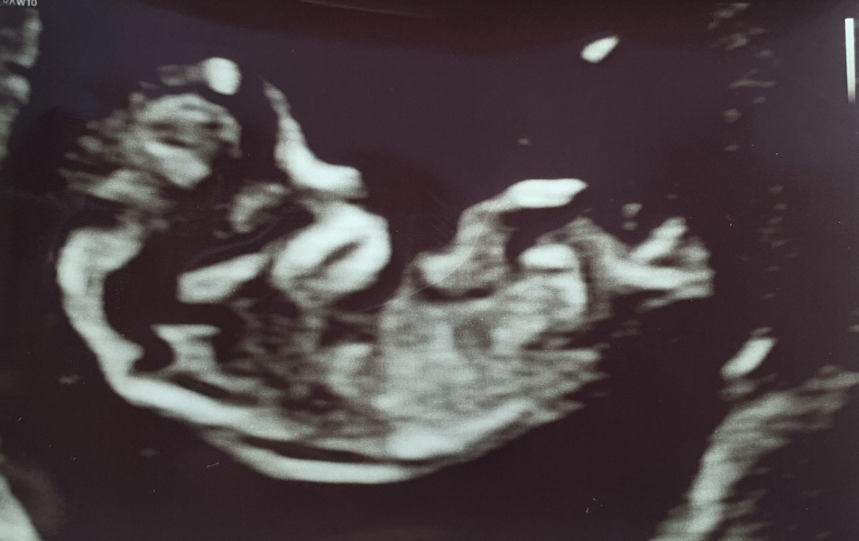 Nub theory? Boy or girl at 11 weeks?